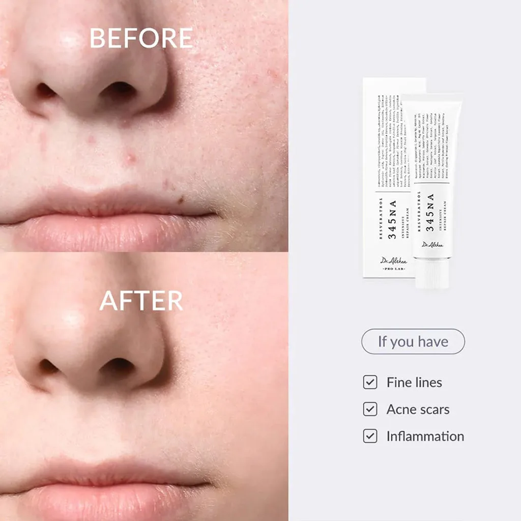 کرم ترمیم کننده جای جوش 345 دکتر التیا