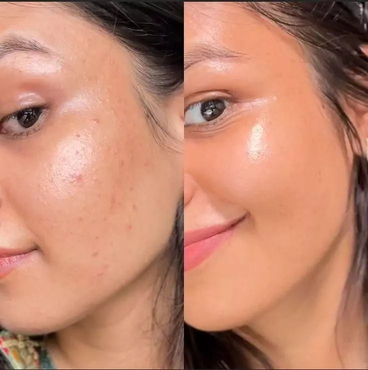 سرم میکرونیدلینگ ریدل شات 100 VT Cosmetics