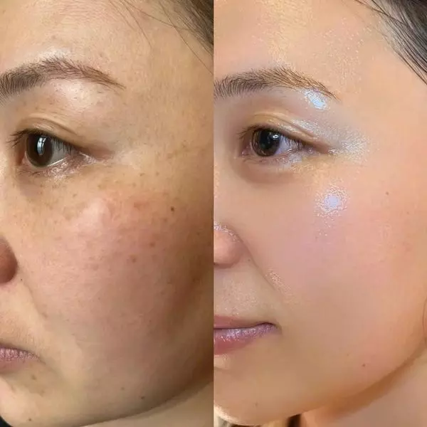 سرم میکرونیدلینگ ریدل شات 100 VT Cosmetics