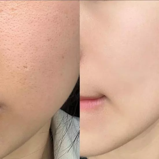 سرم میکرونیدلینگ ریدل شات 100 VT Cosmetics