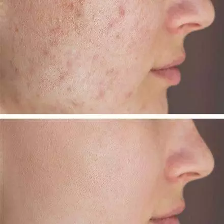 سرم نیاسینامید و روشن کننده آنوا مدل %Niacinamide 10% + TXA 4